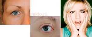 Если выпадают брови что за болезнь Если выпадают брови что за болезнь