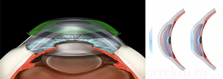 Мягкие контактные линзы для контроля миопии. Линзы для лечения миопии. Ортокератологические ночные линзы. Как работают ортокератологические линзы. Линзы ночные для коррекции зрения для детей.