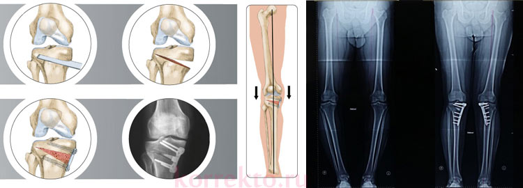 Варусное деформация костей