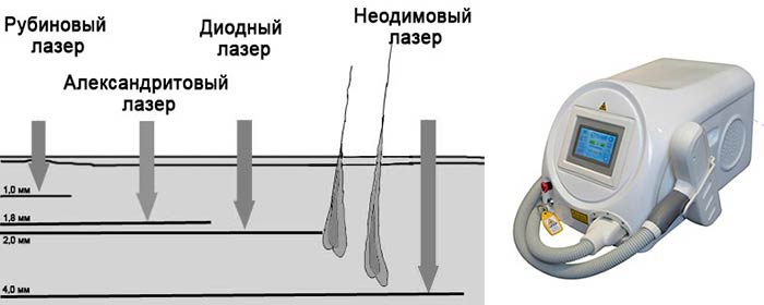 Действие лазеров для выведения татуировки